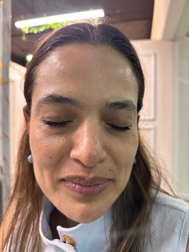 Resultado de piel después de un tratamiento en Ivoncarlo Skin Lab